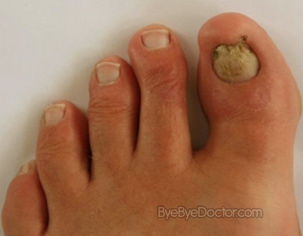 Fungal Nail Infection