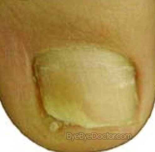 Fungal Nail Infection