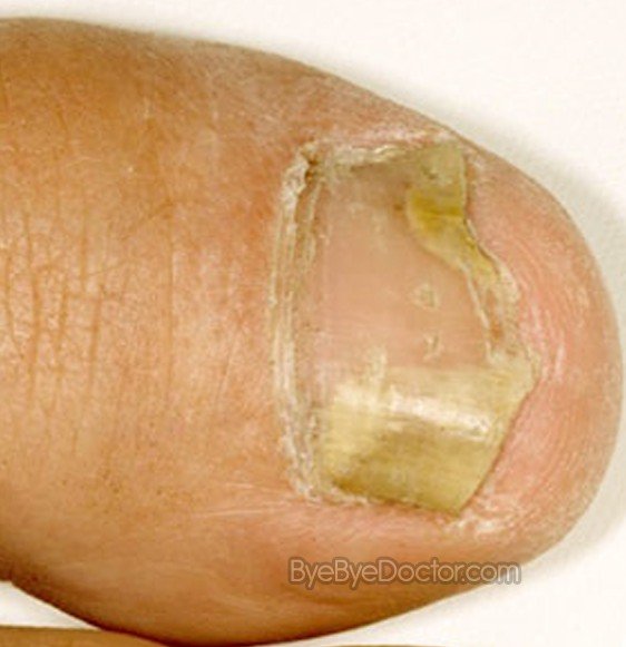 Fungal Nail Infection