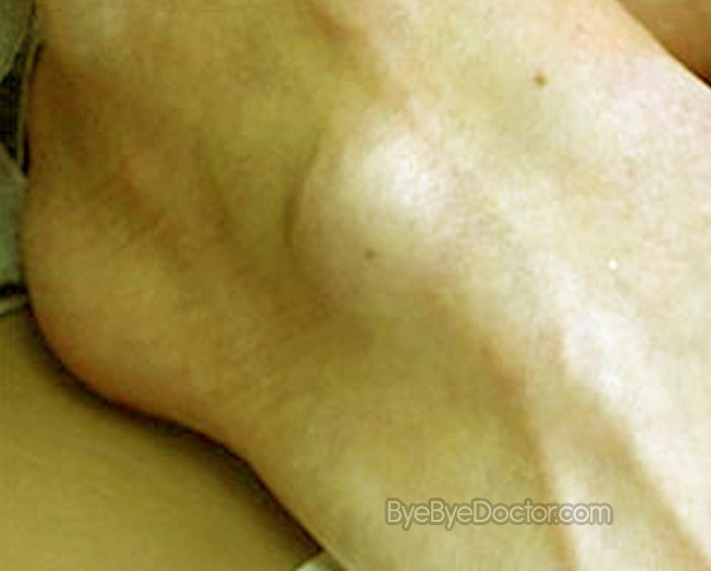 Ganglion Cyst Foot