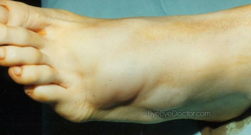 Ganglion Cyst Foot
