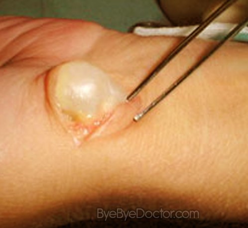 Pictures of Ganglion cyst foot Ganglion cyst foot surgery pictures