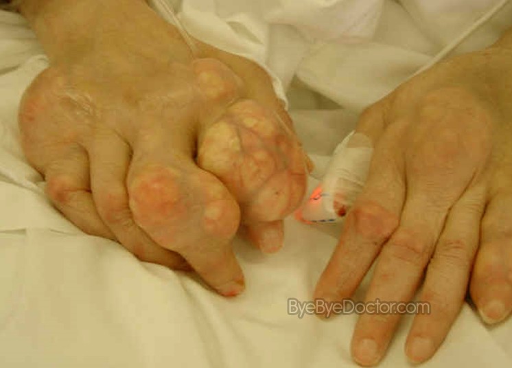 Gout - hands Gout - elbow Gout - hands Gout - foot