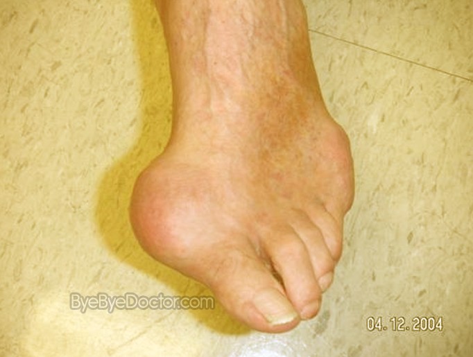 images of gout #10