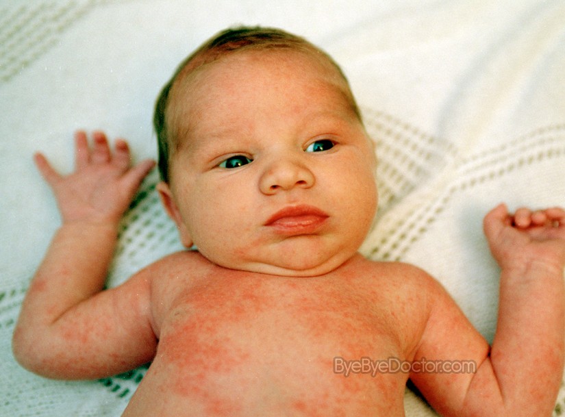 newborn heat rash on face. heat rash pictures in babies.