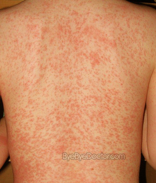 Heat Rash Symptoms