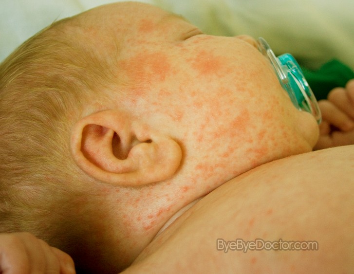 heat rashes in babies. heat rash pictures in abies.