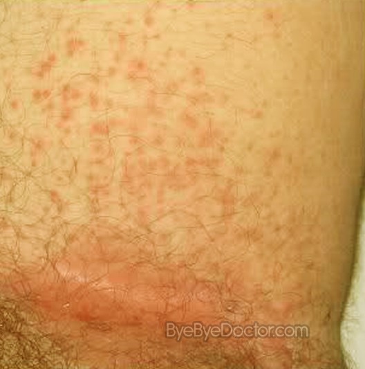Prickly heat (heat rash) - NHS Choices Home Page