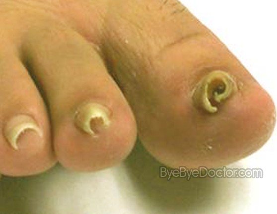 Ingrown Toenail