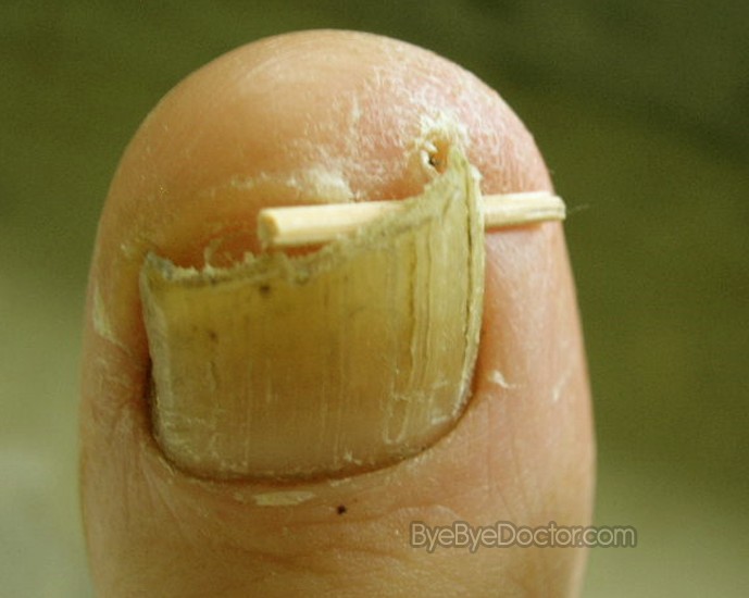 Diseases of the Nails: Slideshow – Medscape