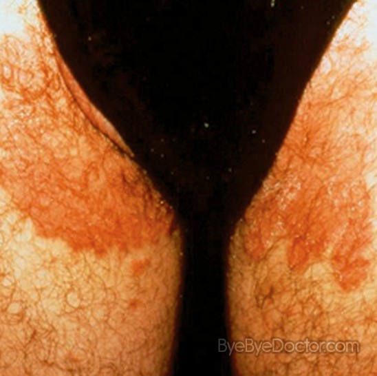 What is a common treatment for groin fungus?