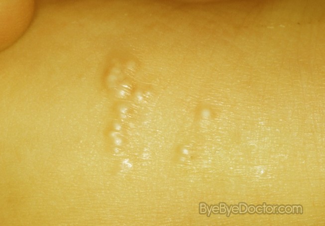 Neonatal Dermatology - Benign Lesions
