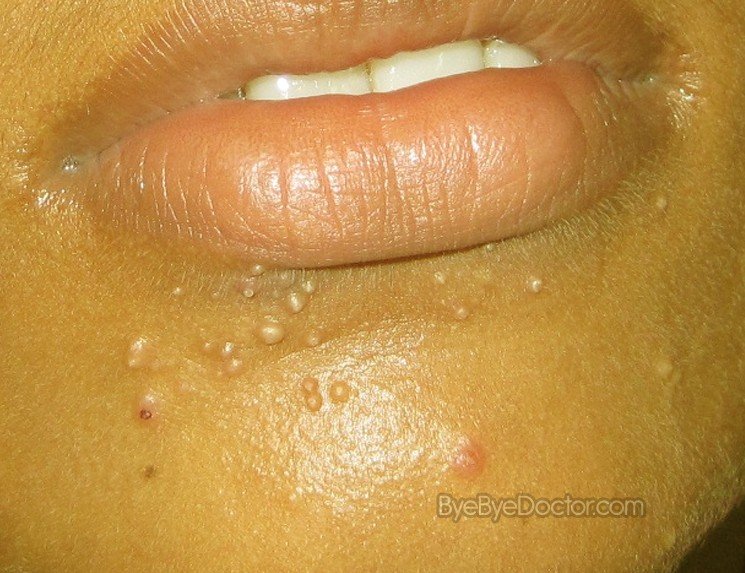 Molluscum Contagiosum