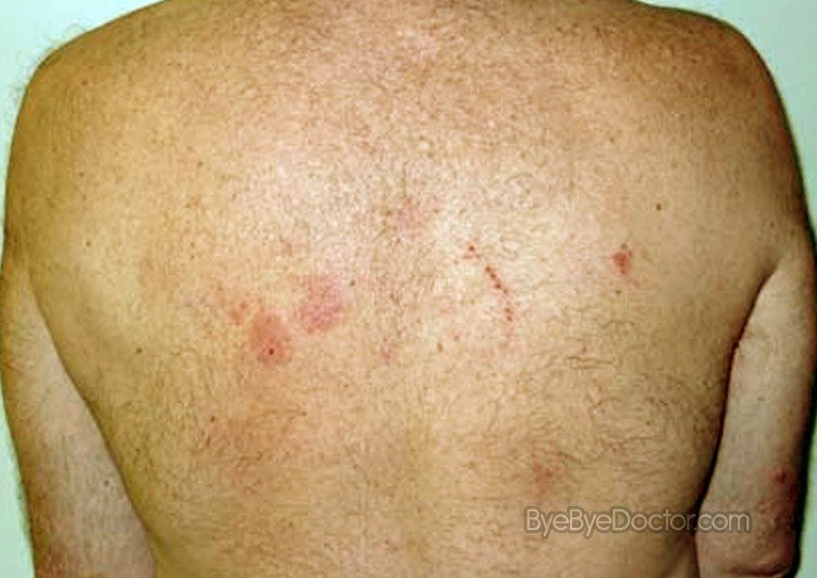 Nummular Dermatitis