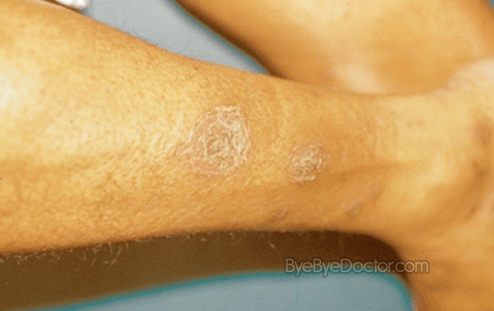 Nummular Dermatitis