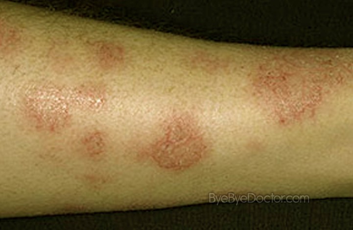Nummular eczema: MedlinePlus Medical Encyclopedia