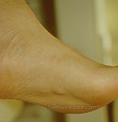 Plantar Fibromatosis