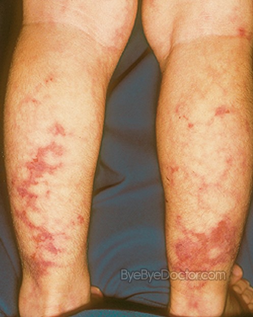 Livedo reticularis: What causes it? - Mayo Clinic