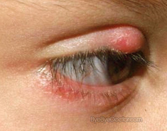 Stye Eye Pictures