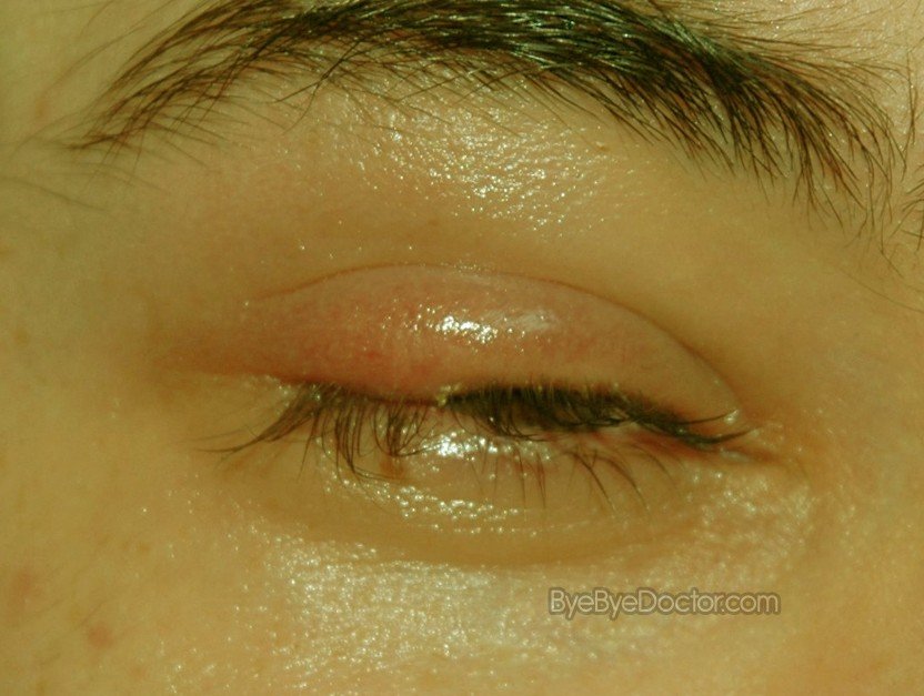 Stye Eye