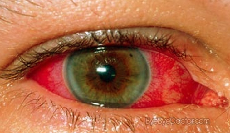 Uveitis – Symptoms, Causes, Pictures and Treatment