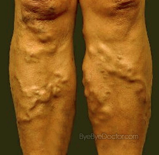 Varicose Veins – Treatment, Symptoms, Causes, Pictures