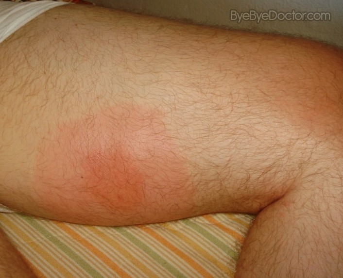 Bee Sting Swelling