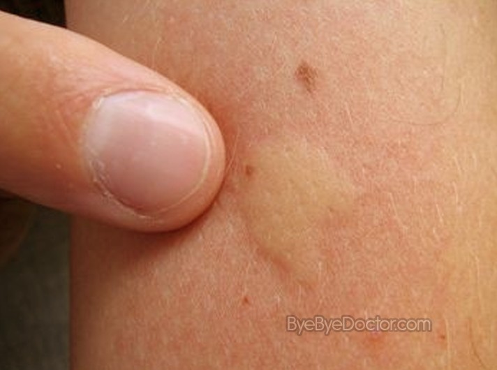 Bug Bite or Sting (Pediatric) in an Infant or ... - skinsight
