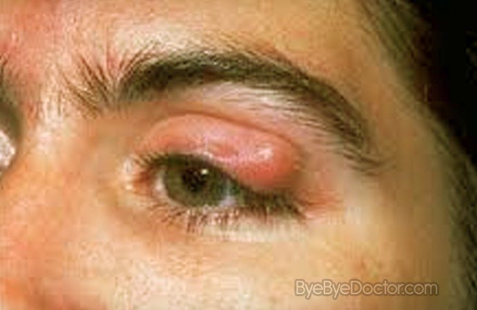 Blepharitis