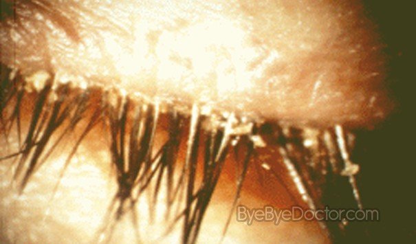 Blepharitis