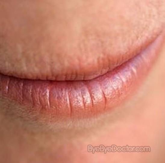 How to Get Rid of Painful Cracked Lips (with Pictures ...