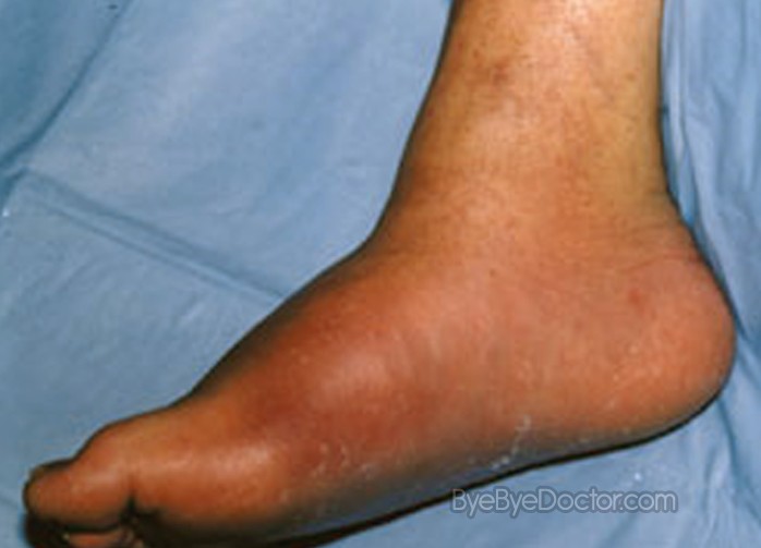 Charcot Joint Disease