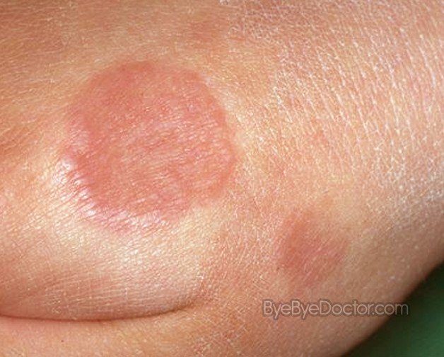 granuloma annulare cure