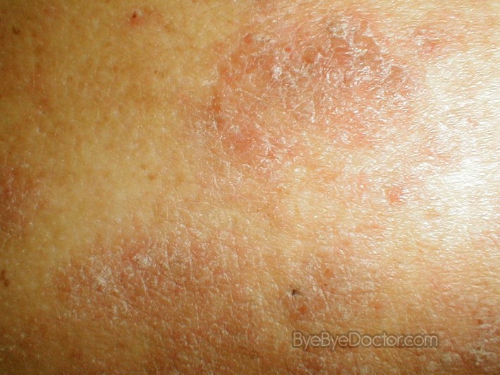 Lichen Simplex Chronicus – Symptoms, Treatment, Pictures ...