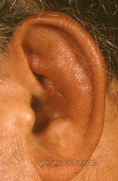 Relapsing Polychondritis