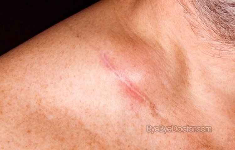 swollen-lymph-nodes-in-back-of-neck