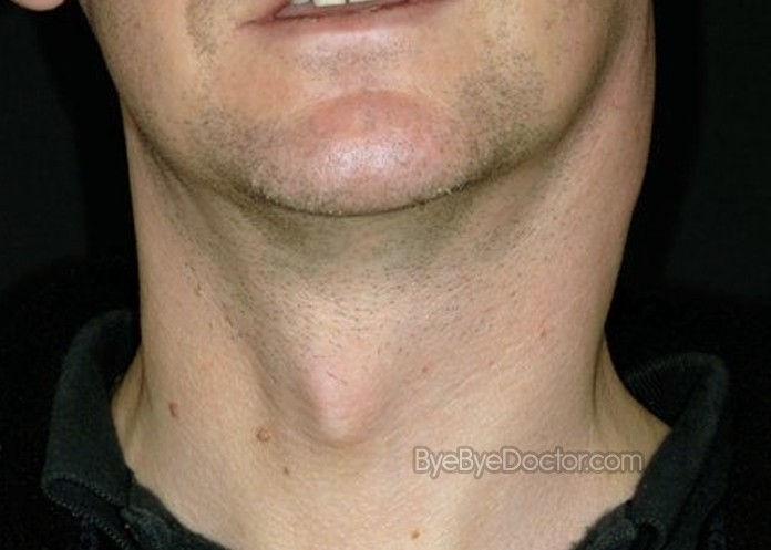 Lymph Nodes Causes Of Swollen Lymph Nodes In Neck