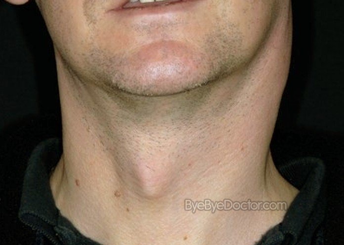 What Causes Lymph Nodes Under Chin To Swell