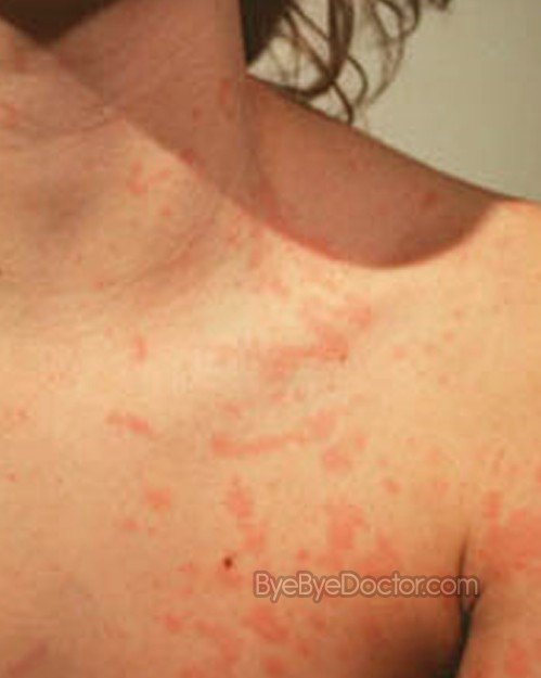 swollen-lymph-nodes-symptoms-causes-diagnosis-treatment-pictures