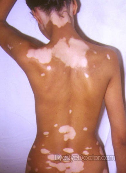 Hypopigmentation — Advanced Dermatology