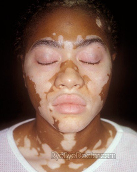 [Image: vitiligo-3.jpg]