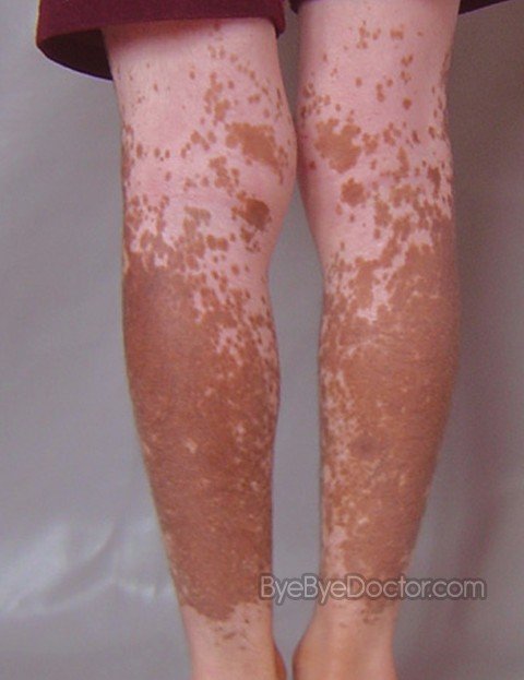 Vitiligo