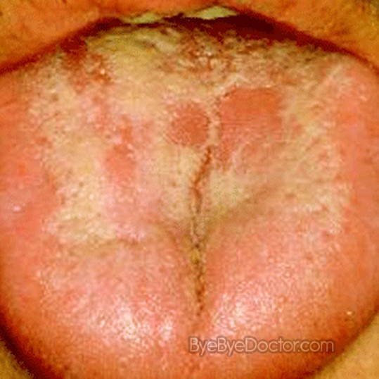 Download this Yeast Infection... picture