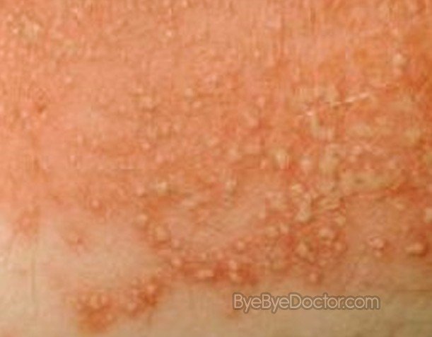 Download this Yeast Infection Pictures picture