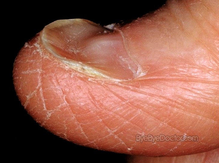 toenail problem pictures #11