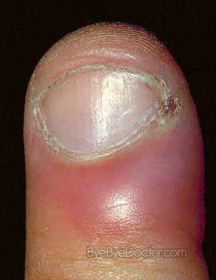 Causes Of Swollen Cuticle: Home Remedies For Acute Paronychia