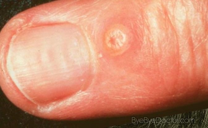 Pilar Cyst - Pictures, Removal, Surgery, Symptoms ...