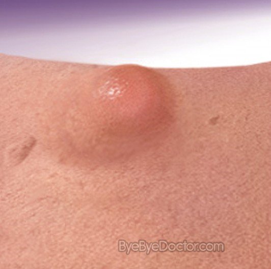 Pilar Cyst Appearance | Dermatology Education