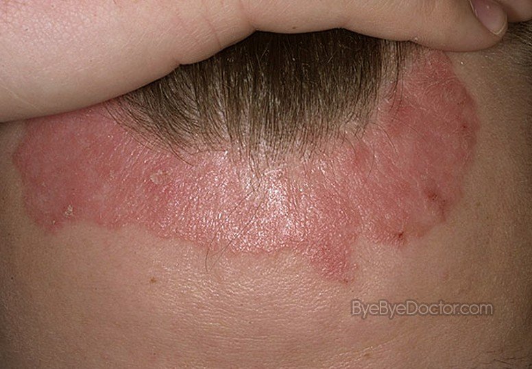 What Causes Scalp Psoriasis Pictures Photos