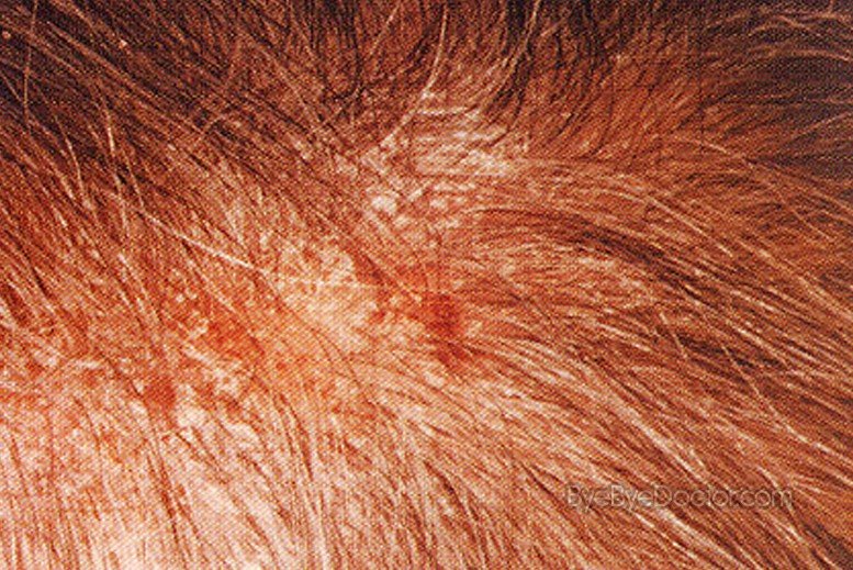 Scalp Psoriasis